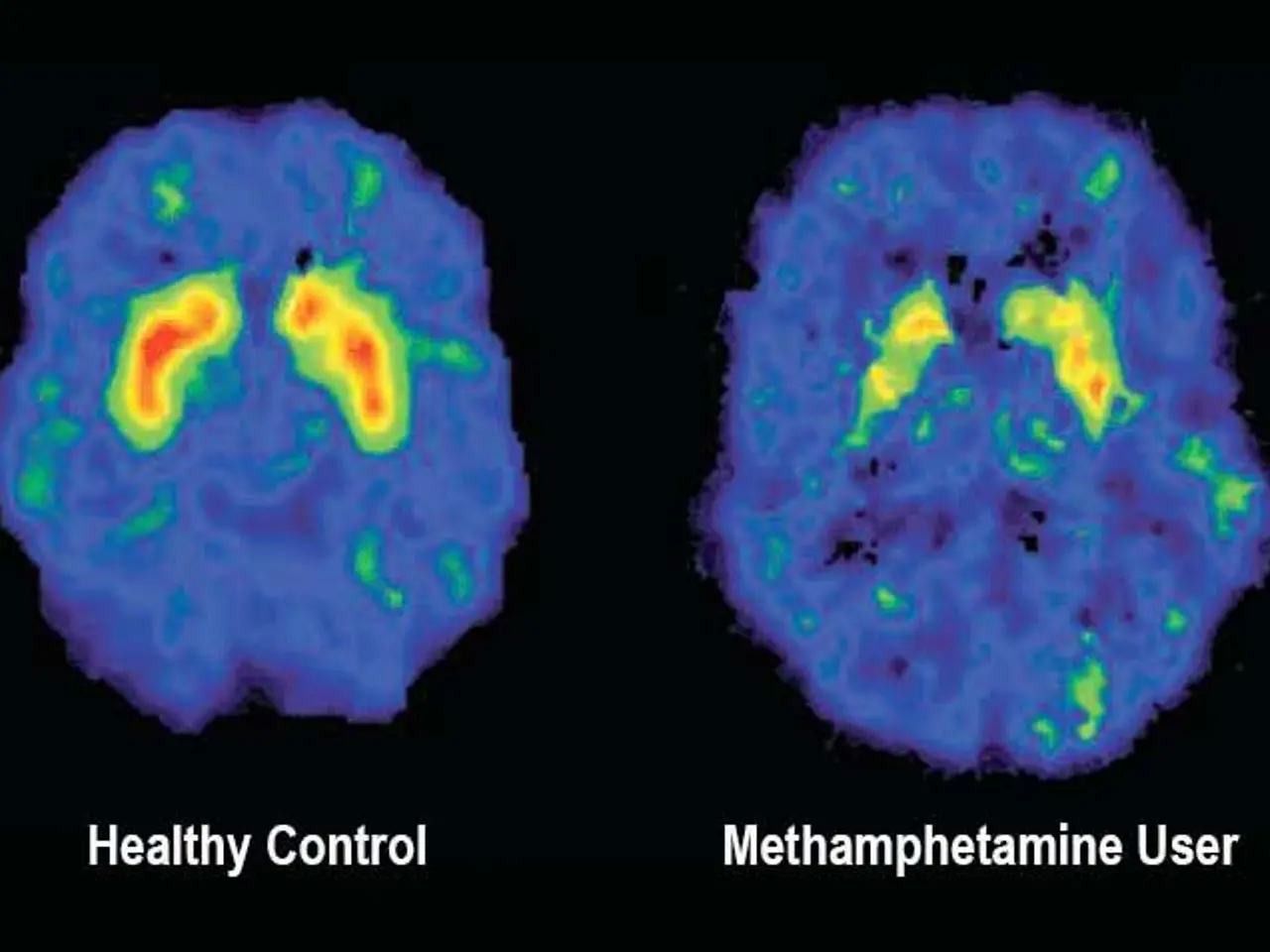 The image shows two MRI images of the brain, one labeled "healthy control" and the other labeled...