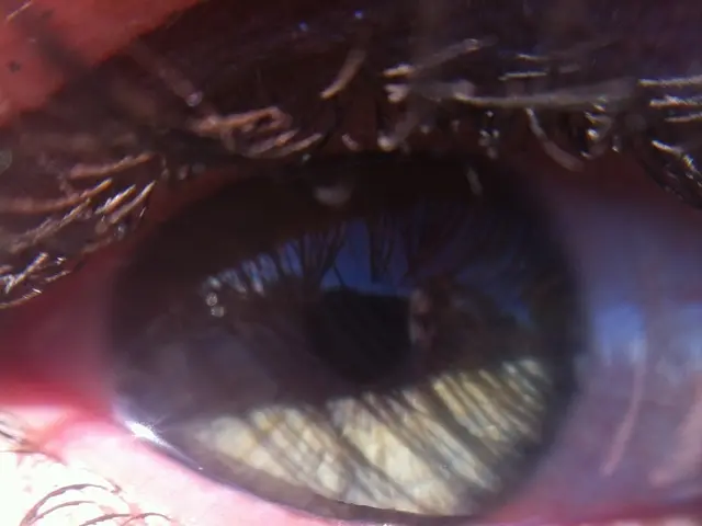 Identifying and Correctly Diagnosing Dry Eye Syndrome