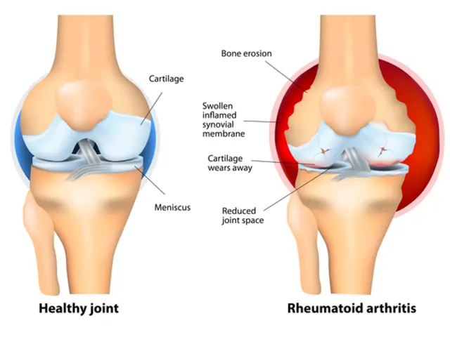 The image shows an animated diagram of a human body with the words "healthy joint" and "rheumatoid...