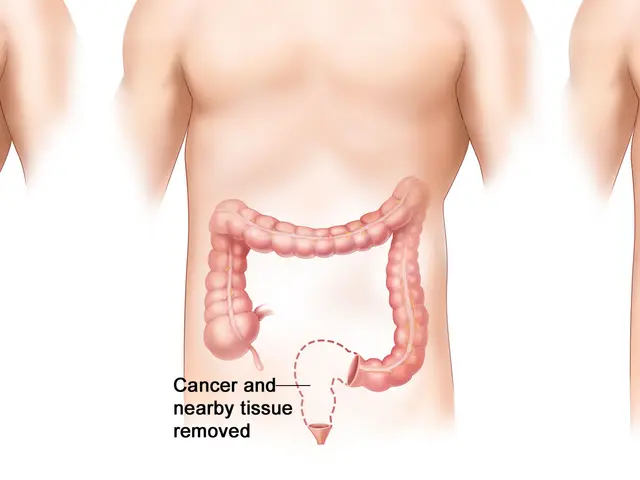 The image shows a diagram of the human body with three different types of colon cancer, each...