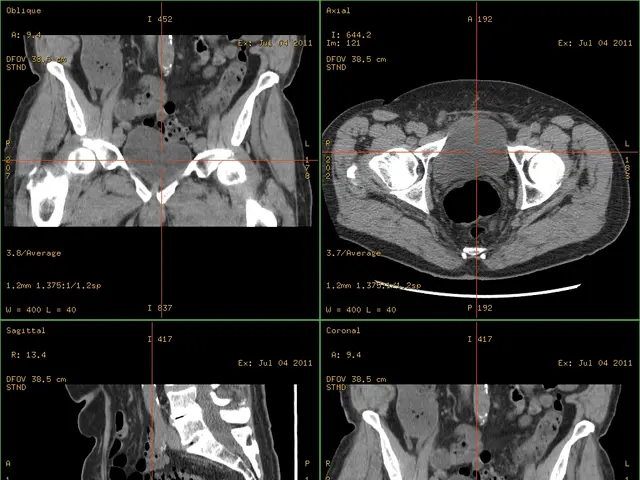 The image shows a CT scan of a patient's abdomen with a green background. The scan is displayed on...