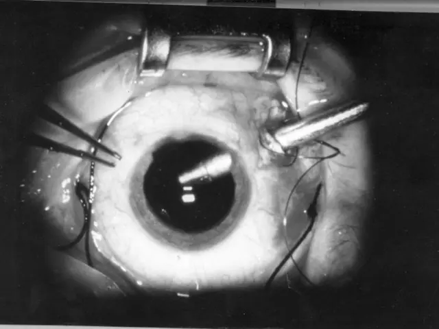 The image shows a black and white photo of a cataract surgery, with a metal object in the center of...