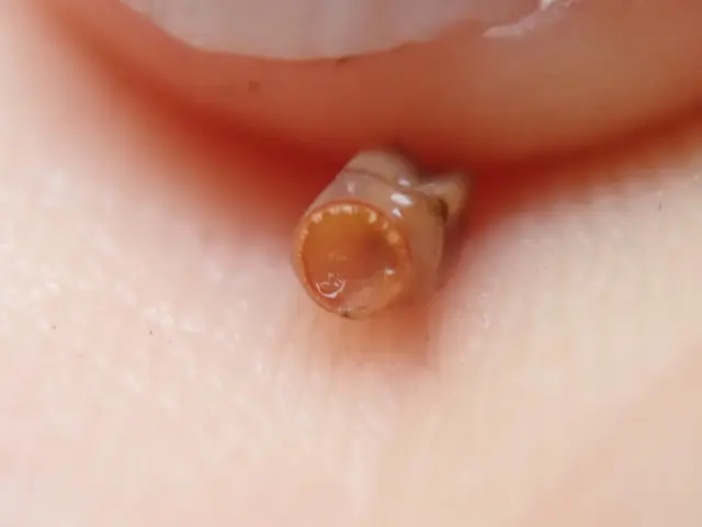 The image shows a close up of a person's ear with a small, brown earplug in the middle of it.