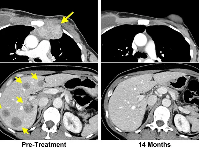 The image shows a ct scan of a patient's chest with a yellow arrow pointing to the left and a black...