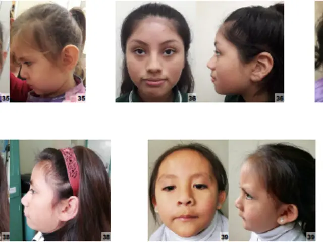 The image shows a collage of nine pictures of a young girl's face before and after rhinoplasty...