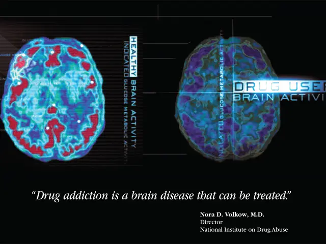 The image shows a brain scan with the words "Drug Addiction is a Brain Disease that can be Treated"...