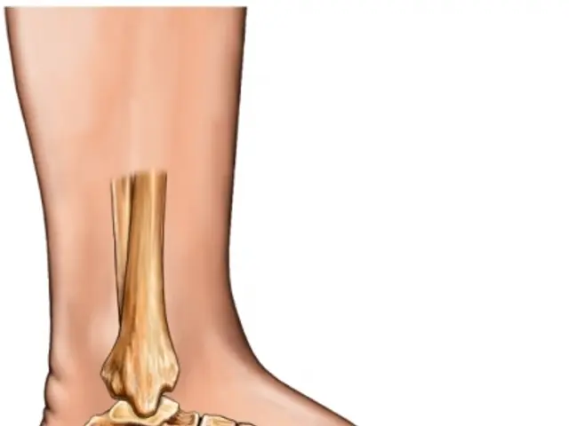 The image shows a diagram of the foot with a fracture in the ankle, providing a visual...