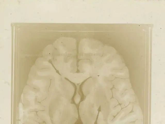 The image shows a black and white photo of a brain with the words "General Oedema of the Brain with...