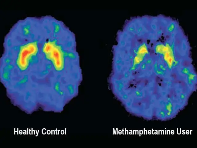 The image shows two MRI images of the brain, one labeled "healthy control" and the other labeled...