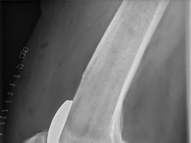 The image shows an x-ray of a human leg with a fracture in the knee, which appears to be a...