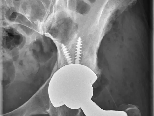 The image shows an x-ray of a hip joint with a screw inserted into it.