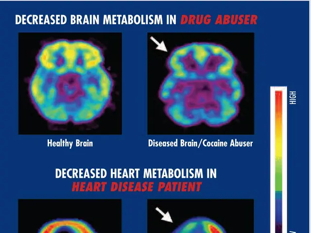 The image shows a poster with a picture of a brain and text that reads "Decreased Brain Metabolism...
