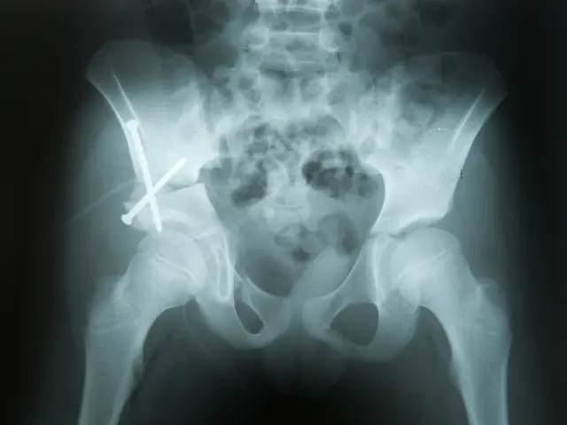 The image shows an x-ray of the hip joint with a fracture in the middle of it, set against a black...